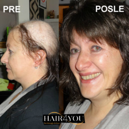 Rešenje za gubitak kose kod žena - Hair Micro System