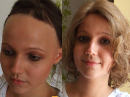 Rešenje za gubitak kose kod dece trakciona alopecija - Hair4You