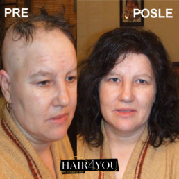 Alopecija totalis rešenje HAIR4YOU