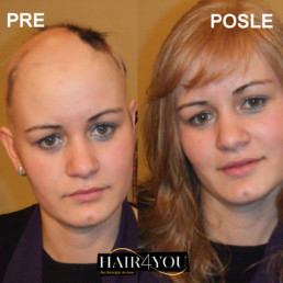 Alopecija totalis rešenje za gubitak kose kod žena - Hair Micro System