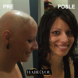 Alopecija totalis rešenje Hair Micro System