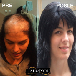 Ožiljna alopecija rešenje HAIR4YOU