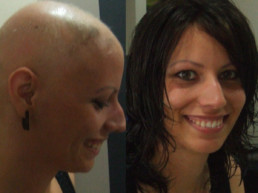 Alopecija totalis rešenje Hair Micro System