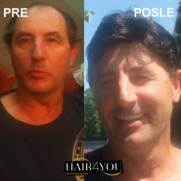 Androgena alopecija rešenje - HAIR4YOU