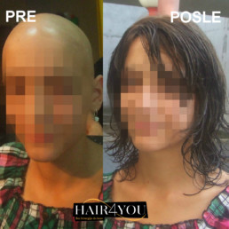 Rešenje za gubitak kose kod dece - Hair4You
