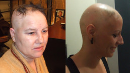 Alopecija totalis - HAIR4YOU