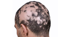 Alopecija areata - rešenje HAIR4YOU