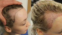 Trakciona alopecija rešenje HAIR4YOU