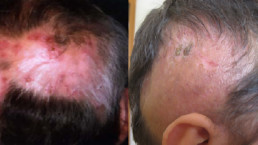 Ožiljna alopecija rešenje HAIR4YOU