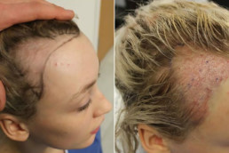 Trakciona alopecija rešenje HAIR4YOU